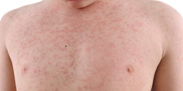 Understanding Skin Lesions: Types, Causes, Diagnosis, and Treatment Options