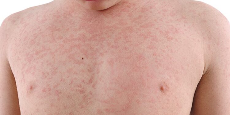 Understanding Skin Lesions: Types, Causes, Diagnosis, and Treatment Options