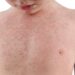 Understanding Skin Lesions: Types, Causes, Diagnosis, and Treatment Options