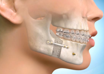 How Long is Your Mouth Wired Shut After Orthognathic Surgery?