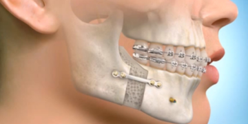 How Long is Your Mouth Wired Shut After Orthognathic Surgery?