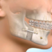 How Long is Your Mouth Wired Shut After Orthognathic Surgery?
